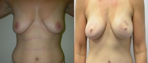 Breast Reconstruction Before and After Picture DIEP SIEA FLAP