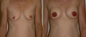 IGAP SGAP Breast Reconstruction 2