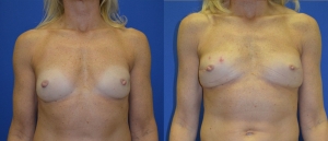 PAP TUG Breast Reconstruction 2