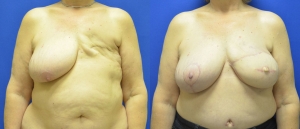 Breast Reconstruction Before and After Picture DIEP SIEA FLAP 4