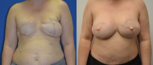 Breast Reconstruction Before and After Picture DIEP SIEA FLAP 5