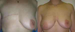 Breast Reconstruction Before and After Picture DIEP SIEA FLAP 6