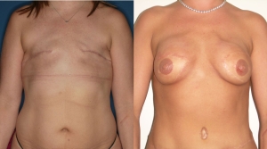 Breast Reconstruction Before and After Picture DIEP SIEA FLAP 7