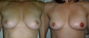 Breast Reconstruction Before and After Picture DIEP SIEA FLAP 8