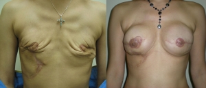 IGAP SGAP Breast Reconstruction 3