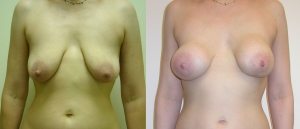 IGAP SGAP Breast Reconstruction 5