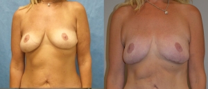 Breast Reconstruction Before and After Picture DIEP SIEA FLAP 10