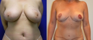 Breast Reconstruction Before and After Picture DIEP SIEA FLAP 11