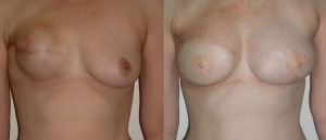 Breast Reconstruction Before and After Picture DIEP SIEA FLAP 13