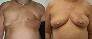 PAP TUG Breast Reconstruction 4