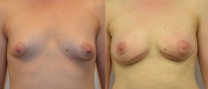 PAP TUG Breast Reconstruction 6