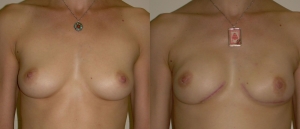 IGAP SGAP Breast Reconstruction 6