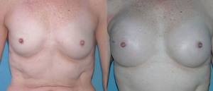 IGAP SGAP Breast Reconstruction 8