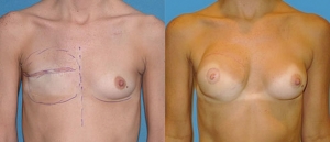 IGAP SGAP Breast Reconstruction 9