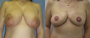 Breast Reconstruction Before and After Picture DIEP SIEA FLAP 15