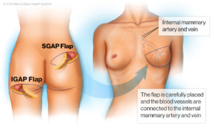 IGAP Breast Reconstruction