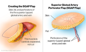 SGAP Flap Breast Reconstruction Illustration
