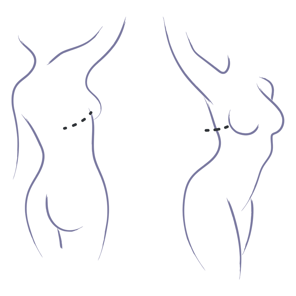 Natural Breast Reconstruction Options