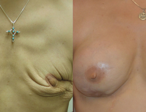 IGAP Before & After photo by Joshua L. Levine, MD