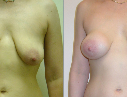 IGAP Flap Before and After Photo by Joshua L. Levine, MD