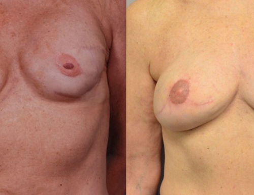 Stacked DIEP & PAP Before & After Photo by Joshua L. Levine, MD