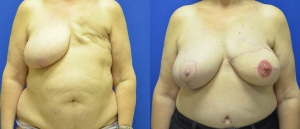 Delayed Unilateral DIEP flap Before and After