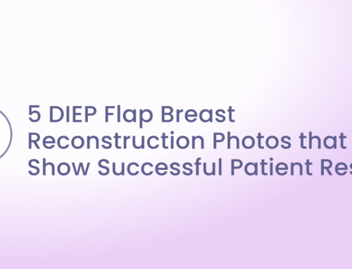 5 DIEP Flap Breast Reconstruction Photos that Show Successful Patient Results