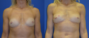 Front PAP Flap Before and After Breast Reconstruction Photo