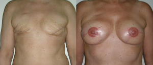 Front SGAP Flap Before and After Breast Reconstruction Photo
