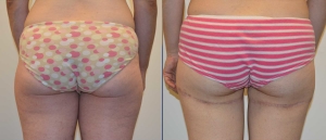 Before and After Pap Flap Breast Reconstruction Photo Behind