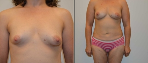 Before and After Pap Flap Breast Reconstruction Photo
