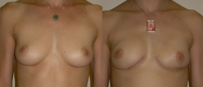 IGAP Before and After Front