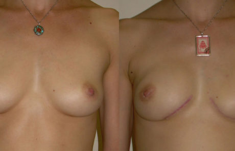 IGAP Before and After Front