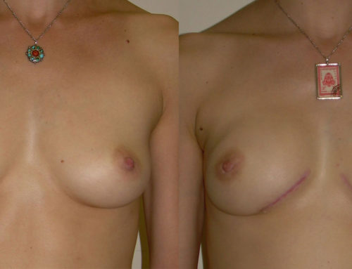 IGAP Flap Before and After Photo by Joshua Levine, MD