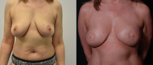 Pap Flap Breast Reconstruction Before and After Photo