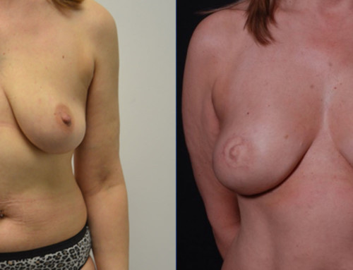 PAP Flap Before and After Photo by Joshua Levine, MD