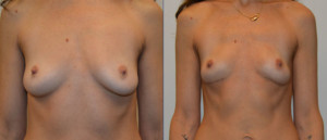 Front Bilateral Mastectomy w/ Bilateral PAP flap