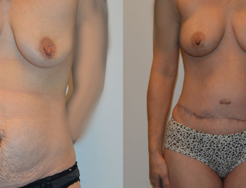DIEP Flap Reconstruction Before and After Photo by Joshua L. Levine, MD