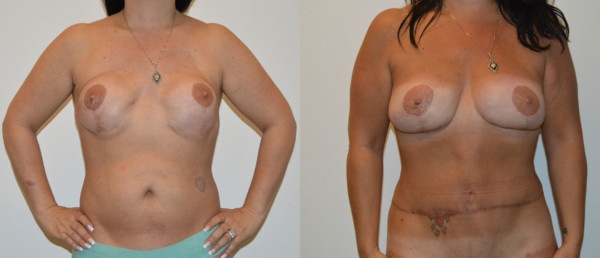 Front Diep Flap Breast Reconstruction Before and After Photo