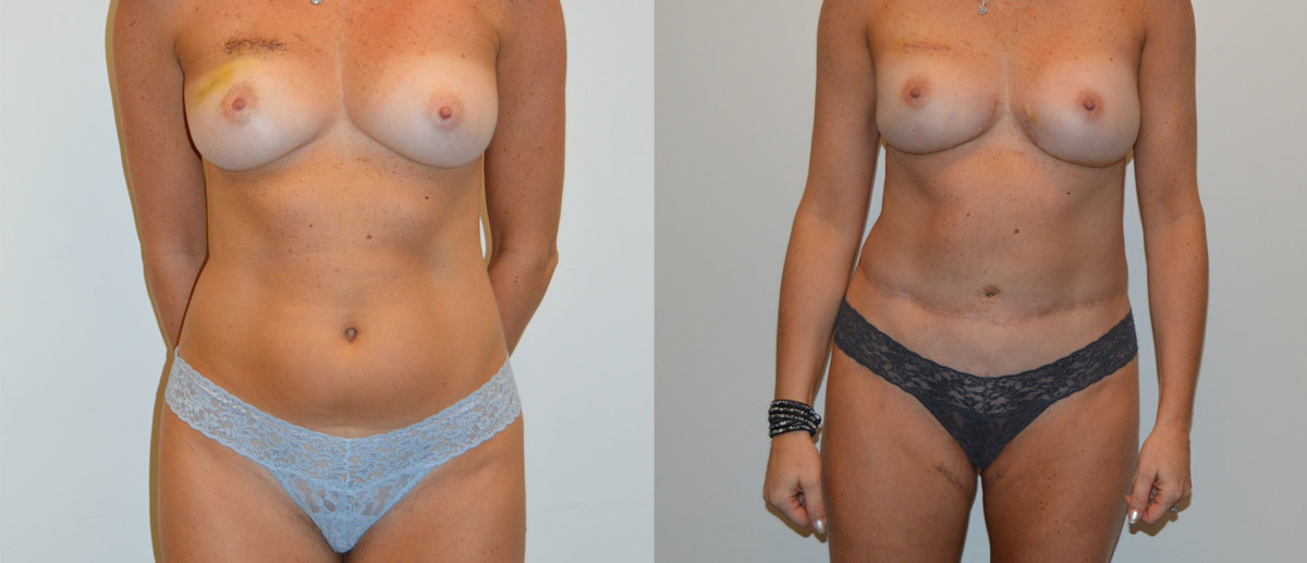 Front Stacked Combination DIEP PAP Flap Breast Reconstruction Before and After Photo