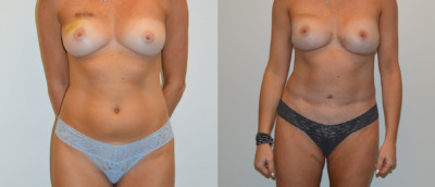 Front Stacked Combination DIEP PAP Flap Breast Reconstruction Before and After Photo