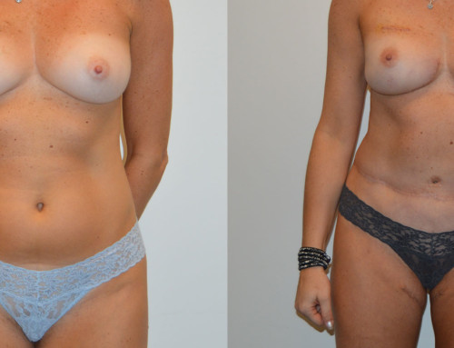 Stacked Combination DIEP & PAP Flap Reconstruction Before and After Photo by Joshua L. Levine, MD