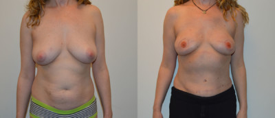 Front Diep Flap Breast Reconstruction Before and After Photo
