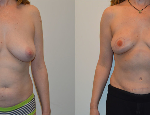 SHaEP Flap Reconstruction Before and After Photo by Joshua L. Levine, MD