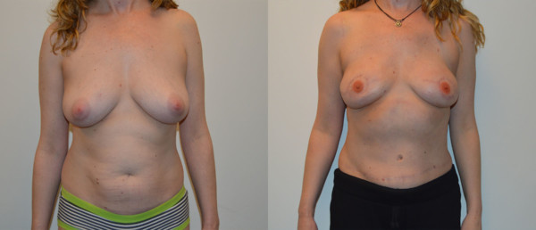Front Diep Flap Breast Reconstruction Before and After Photo