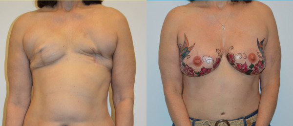 Front Diep Flap Breast Reconstruction Before and After Photo