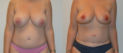 Front Diep Flap Breast Reconstruction Before and After Photo