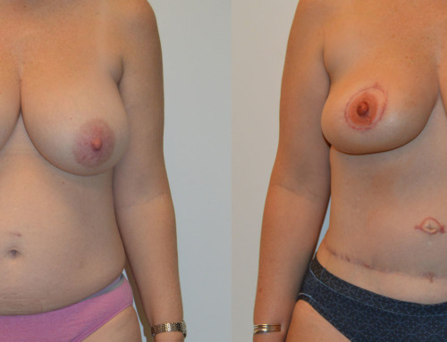 SHaEP Flap Reconstruction Before and After Photo by Joshua L. Levine, MD
