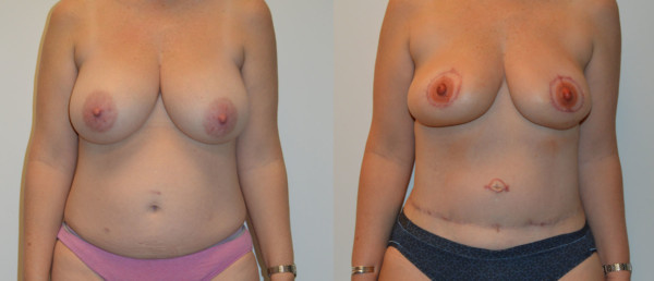 Front Diep Flap Breast Reconstruction Before and After Photo