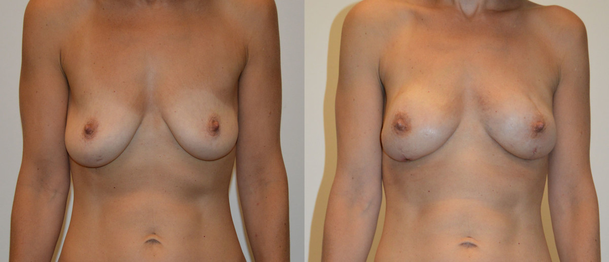 Front Pap Flap Breast Reconstruction Before and After Photo